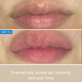 LIP INJECTION freezeframeau